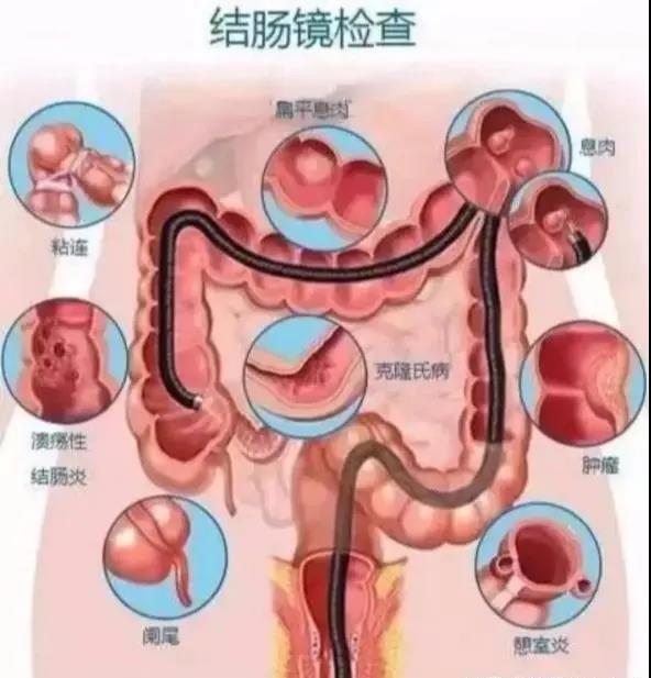 如果出现上述症状一定要就医,特别是由肠道改变的,做个直肠指诊