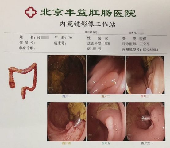 内痔肠镜下图片大全图片